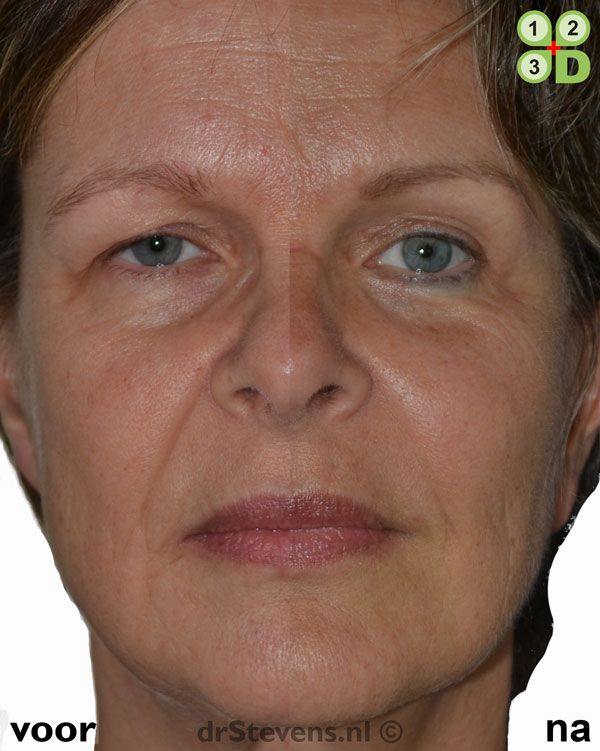 macs-lift voorhoofdslift lipofilling aangezicht vrouw - drstevens.nl