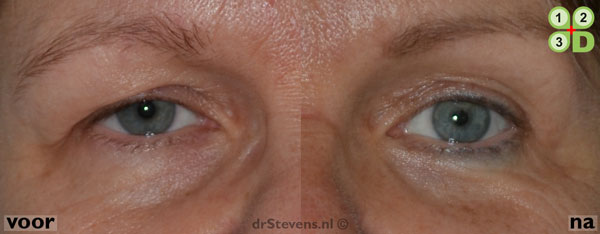 macs-lift voorhoofdslift lipofilling aangezicht vrouw - drstevens.nl