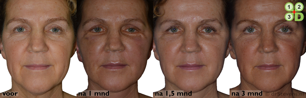 56 jarige vrouw - Macs-ligt, ooglidcorrectie & lipofilling - drStevens.nl