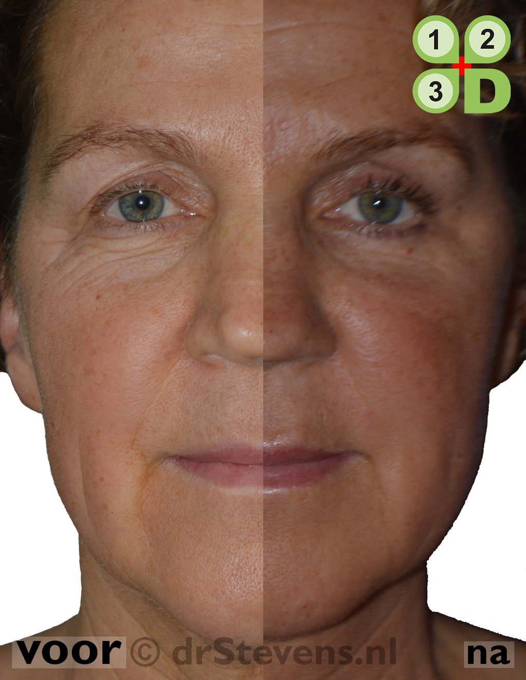 56 jarige vrouw - Macs-ligt, ooglidcorrectie & lipofilling - drStevens.nl