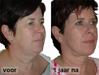 macslift vermoeide-ogen aangezicht vrouw - drstevens.nl