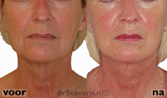 nabloeding macs-lift aangezicht vrouw - drstevens.nl