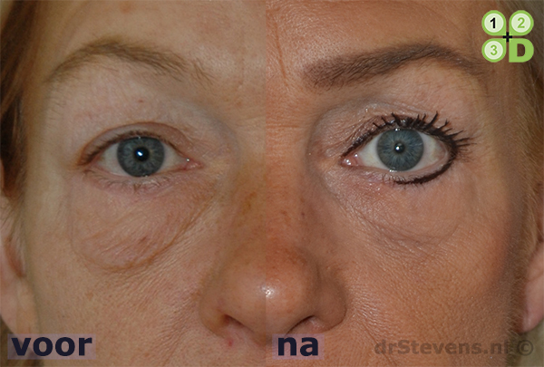 onderooglidcorrectie aangezicht vrouw - drstevens.nl