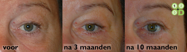 ooglidcorrectie aangezicht vrouw - drstevens.nl
