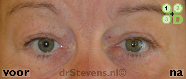 ooglidcorrectie aangezicht vrouw - drstevens.nl