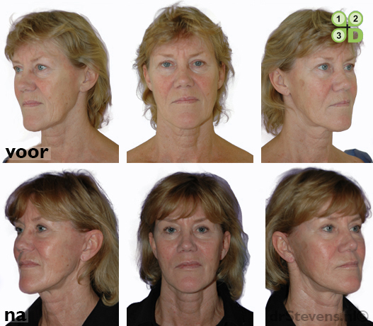 ooglidcorrectie facelift lipofilling aangezicht vrouw - drstevens.nl