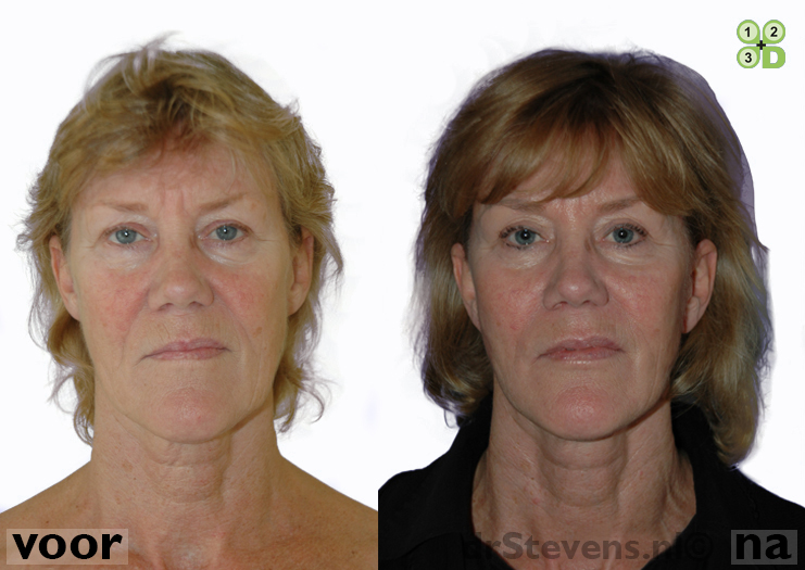 ooglidcorrectie facelift lipofilling aangezicht vrouw - drstevens.nl