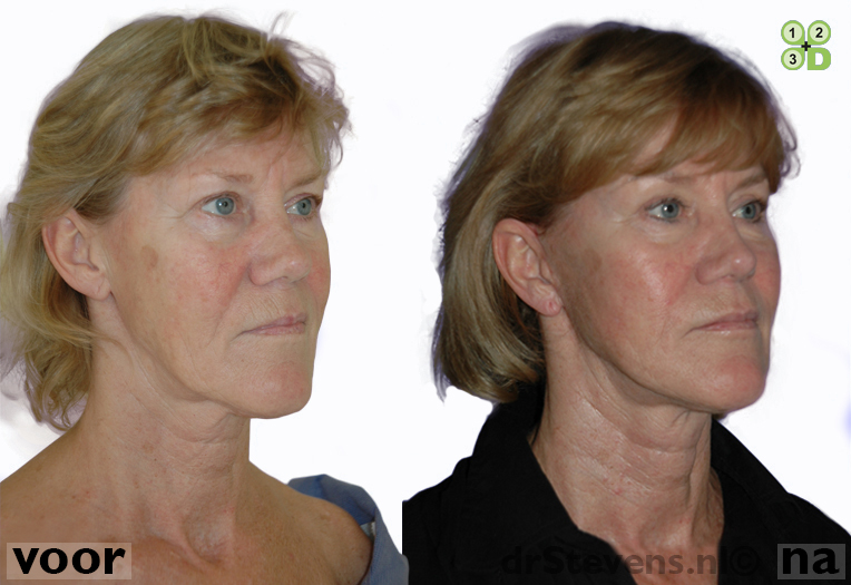 ooglidcorrectie facelift lipofilling aangezicht vrouw - drstevens.nl