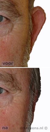 oorcorrectie afstaand-oor aangezicht man - drstevens.nl