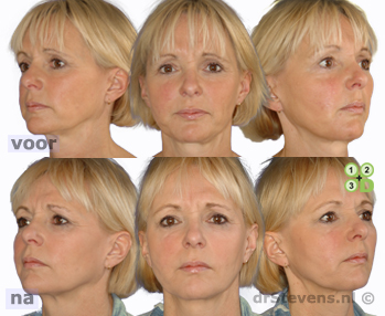 s-lift lipofilling aangezicht vrouw - drstevens.nl