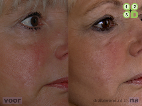 s-lift lipofilling aangezicht vrouw - drstevens.nl