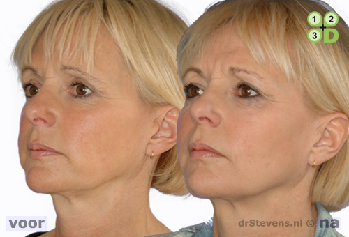 s-lift lipofilling aangezicht vrouw - drstevens.nl