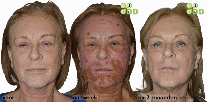 Zie hier het resultaat van een zeer tevreden cliente na lipofilling met groeifactoren uit eigen bloedplaatsjes en een aanvullende peeling