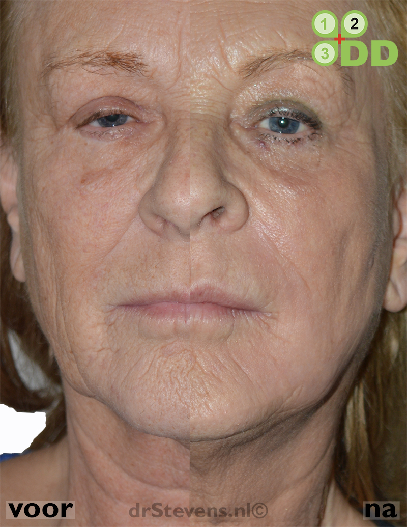 Zie hier het resultaat van een zeer tevreden cliente na lipofilling met groeifactoren uit eigen bloedplaatsjes en een aanvullende peeling.