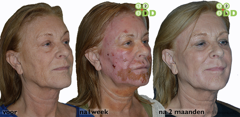 Zie hier het resultaat van een zeer tevreden cliente na lipofilling met groeifactoren uit eigen bloedplaatsjes en een aanvullende peeling