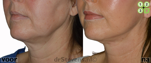 voorhoofdslift hals-facelift lipofilling aangezicht vrouw - drstevens.nl