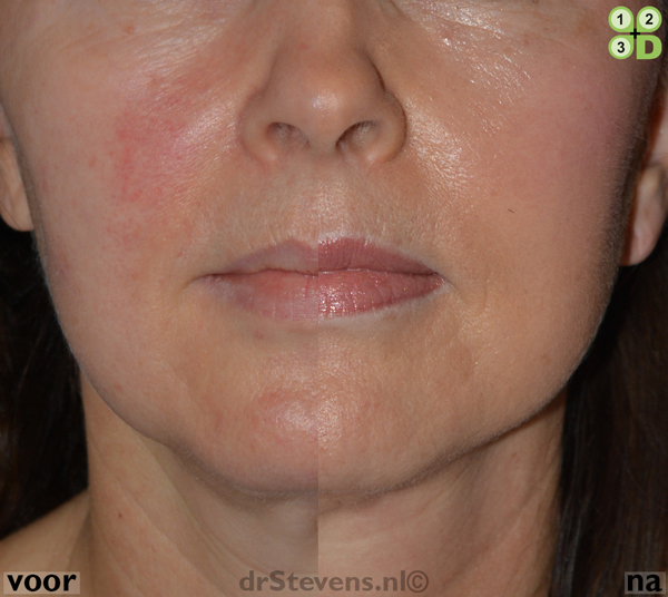 voorhoofdslift hals-facelift lipofilling aangezicht vrouw - drstevens.nl