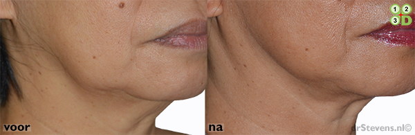 wenkbrauwlift ooglidcorrectie macs-lift lipofilling groeifactoren aangezicht vrouw - drstevens.nl