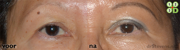 wenkbrauwlift ooglidcorrectie macs-lift lipofilling groeifactoren aangezicht vrouw - drstevens.nl