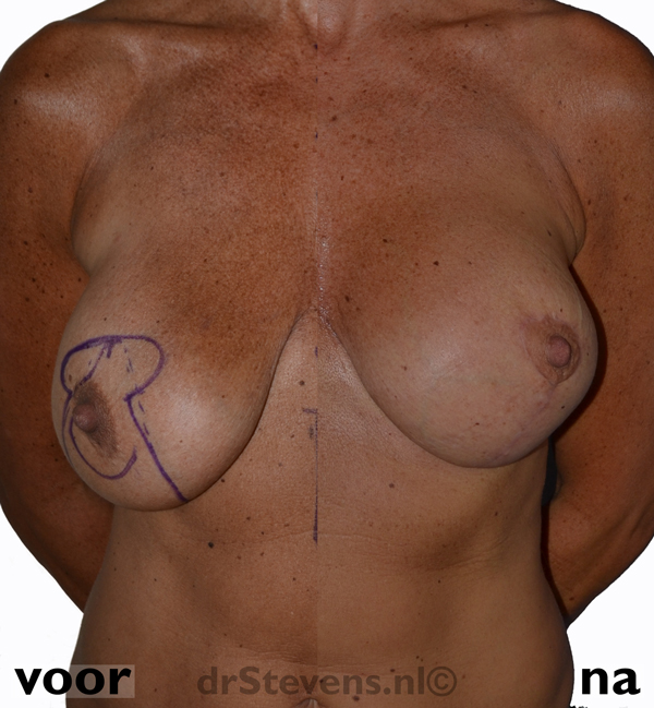 borstlift prothese vrouw - drstevens.nl