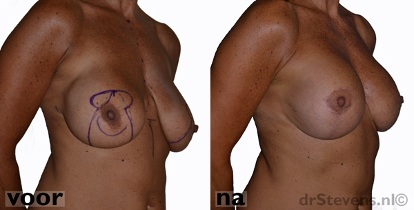 borstlift prothese vrouw - drstevens.nl