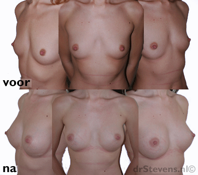 borstvergroting 260cc vrouw - drstevens.nl