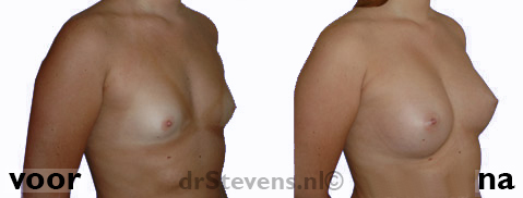 borstvergroting 75C vrouw - drstevens.nl