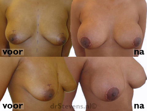 borstvergroting borstlift 400cc siliconen prothese vrouw - drstevens.nl