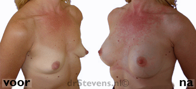 borstvergroting drain vrouw - drstevens.nl