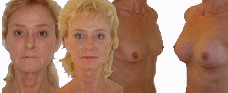 borstvergroting facelift vrouw - drstevens.nl