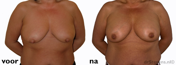borstvergroting prothese vrouw - drstevens.nl