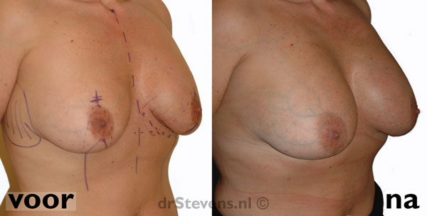 borstvergroting silicone prothese vrouw - drstevens.nl