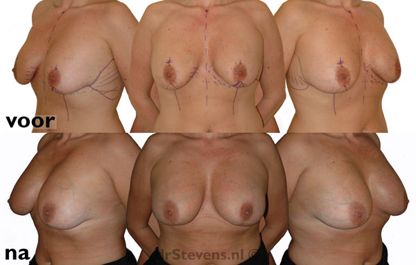 borstvergroting silicone prothese vrouw - drstevens.nl