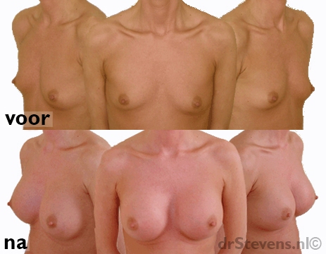 borstvergroting siliconen-prothese 400cc vrouw - drstevens.nl