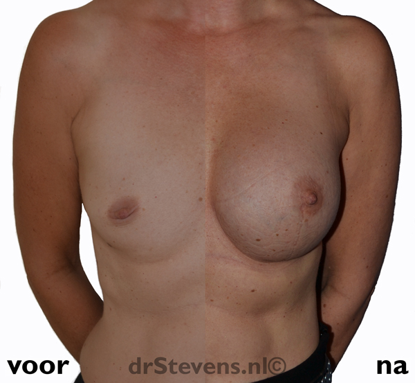 borstvergroting weinig-borstvorming vrouw - drstevens.nl