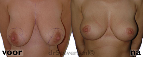 borstverkleining vrouw - drstevens.nl
