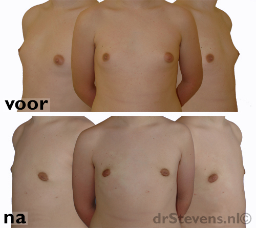 gynaecomastie lipposculptuur borstvorming man - drstevens.nl