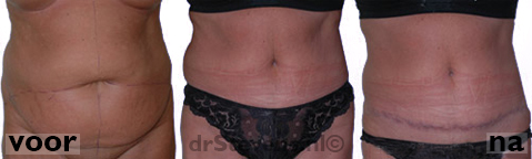 buikwandcorrectie liposculpture buik vrouw - drstevens.nl