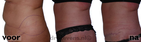 buikwandcorrectie liposculpture buik vrouw - drstevens.nl