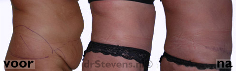 buikwandcorrectie liposculpture buik vrouw - drstevens.nl