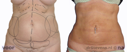 liposuctie maag-buik-flank vrouw - drstevens.nl