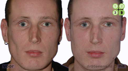 asymmetrich-gezicht lipofilling man - drstevens.nl