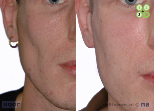 asymmetrich-gezicht lipofilling man - drstevens.nl