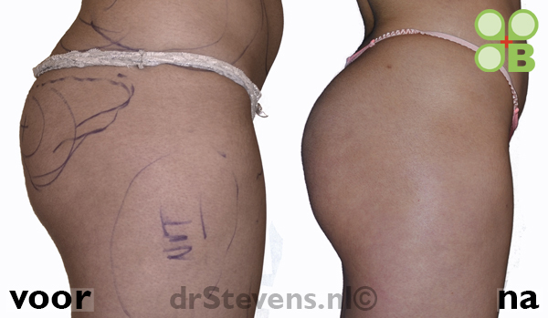 bilvergroting lipofilling groeifactoren vrouw - drstevens.nl