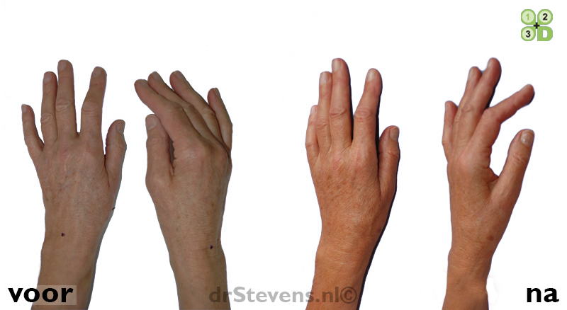 hand-verjonging lipofilling vrouw - drstevens.nl