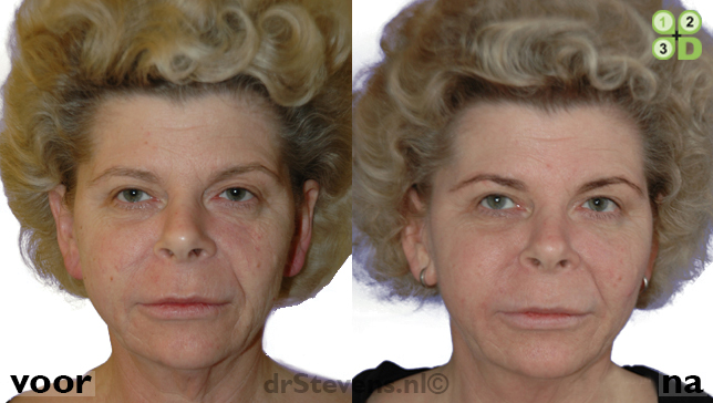 littekens gezicht lipofilling groeifactoren vrouw - drstevens.nl