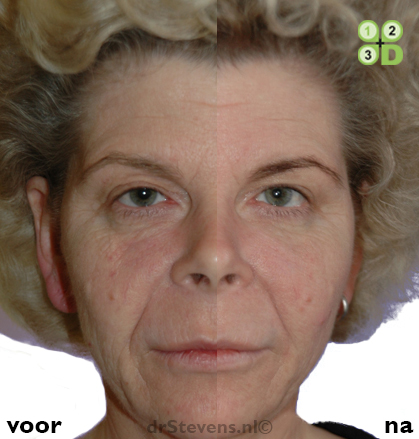 littekens gezicht lipofilling groeifactoren vrouw - drstevens.nl